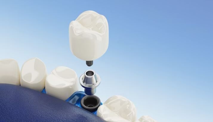 implantes dentales Vigo